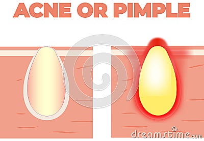 Acne growing with a lot of pus and giving a red hurting alert vector. Bron or pimple on the skin with yellow pus. Pus growing Vector Illustration