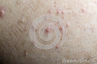 Acne on the human skin that is caused by the cover Stock Photo