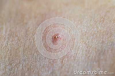 Acne on the human skin that is caused by the cover Stock Photo