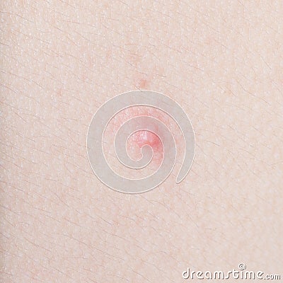 Acne on human skin closeup Stock Photo