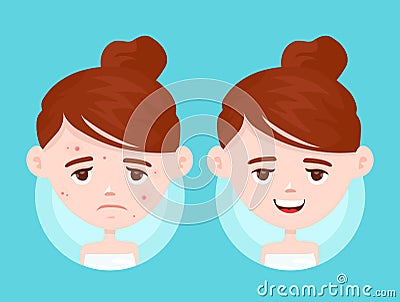 Acne infographic. Vector modern flat style Vector Illustration