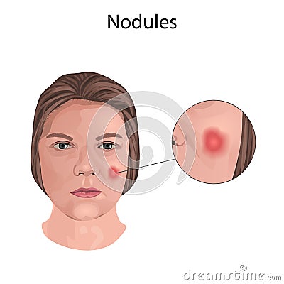 Acne. Nodules. Young woman face with skin inflammation. Close-up view. Stock Photo