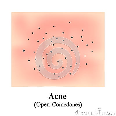 Acne, Open Comedones. Skin with blackheads. Black spots. Acne on the skin. Infographics. Vector illustration. Vector Illustration