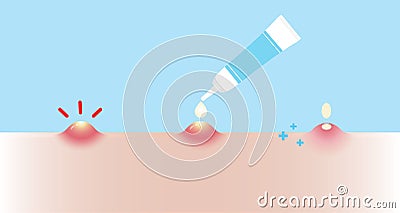 Acne pimple treatment for pustule vector illustration on sky blue background. Vector Illustration