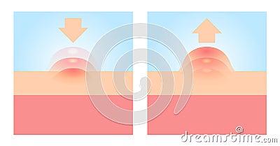 Acne and Pimples, stages of development, vector icon Vector Illustration