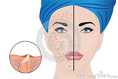 Acne pustules on a woman face and a treatment result Vector Illustration