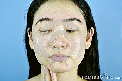 Acne scar skin facial problem, Asian woman annoy and bored about hormonal pimples. Stock Photo