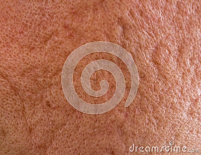 Acne scars on cheek Stock Photo