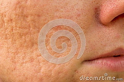 Acne scars Stock Photo