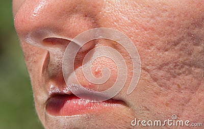 Acne scars Stock Photo