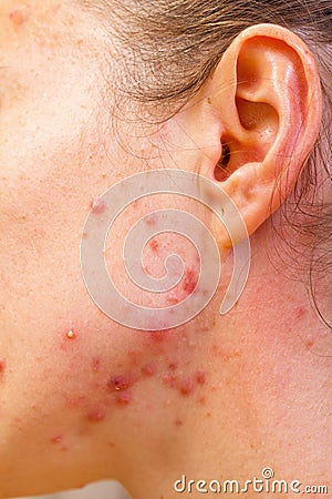 Acne skin Stock Photo