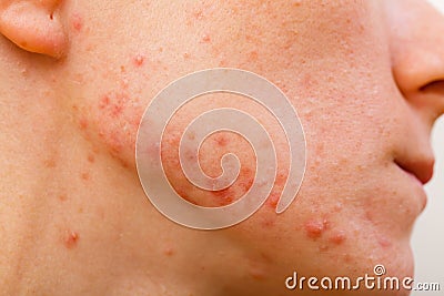 Acne skin Stock Photo