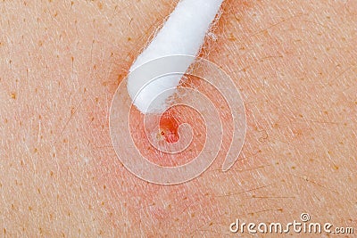 Acne on skin Stock Photo