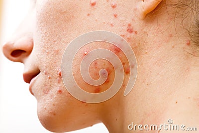 Acne skin Stock Photo