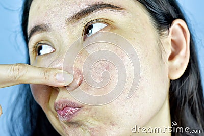 Acne skin problem, Asian woman annoy and bored about hormonal pimples. Stock Photo