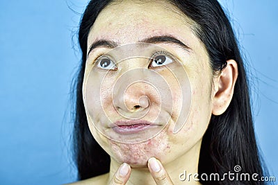 Acne skin problem, Asian woman annoy and bored about hormonal pimples. Stock Photo