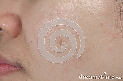 Acne spot on face skin of Asian woman. Concept before face laser Stock Photo