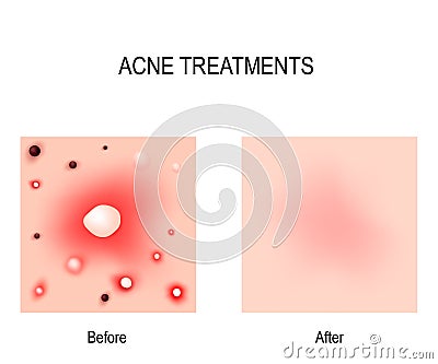 Acne Treatment. Before and after. Skin problems Vector Illustration