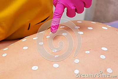 Acne treatment with zinc ointment. The back of a woman. The hands of a cosmetologist smear skin rashes with ointment. Stock Photo