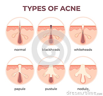 Acne types anatomy. Pimple diseases sectional view blackhead, cystic and whitehead. Structure of skin and pore infection Vector Illustration