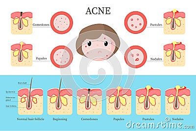 Acne types and formation infographics, vector flat illustration Vector Illustration