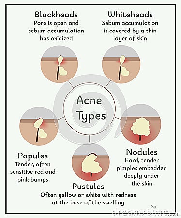 Acne types. Medical illustration. Infographic about skin and dermatology Vector Illustration