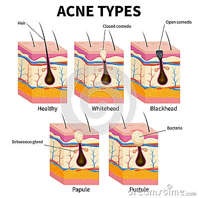 Acne types. Pimple skin diseases anatomy medical vector diagram Vector Illustration