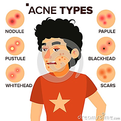 Acne Types Vector. Boy With Acne. Pimples, Wrinkles, Dry Skin, Blackheads. Isolated Flat Cartoon Character Illustration Vector Illustration
