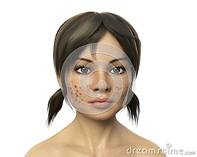 Acne vulgaris on skin Cartoon Illustration
