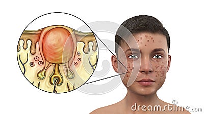 Acne vulgaris in a teenager boy and white comedone Cartoon Illustration