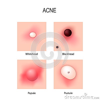 Acne vulgaris. stages of development. Types of pimples. Vector Illustration