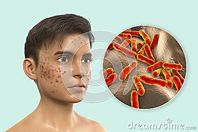 Acne vulgaris and bacteria Cutibacterium acnes Cartoon Illustration