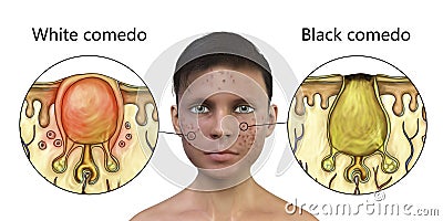 Acne vulgaris in a teenager boy, white and black comedo Cartoon Illustration