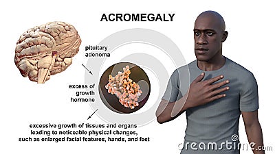 Acromegaly, 3D illustration Cartoon Illustration