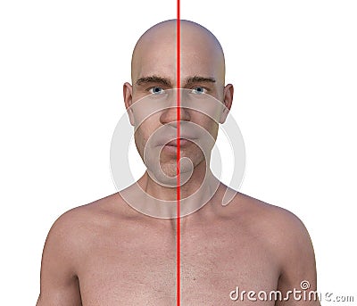 Acromegaly in a man, and the same healthy person, 3D illustration Cartoon Illustration