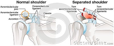 Acromioclavicular joint separation or AC joint separation or shoulder separation. Illustration Stock Photo