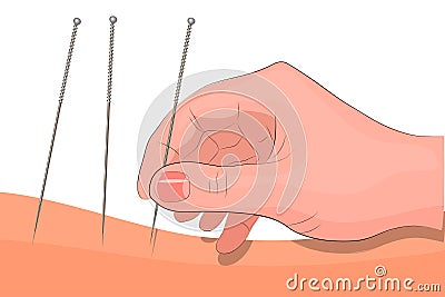 Acupuncture. hand and needle for acupuncture Vector Illustration