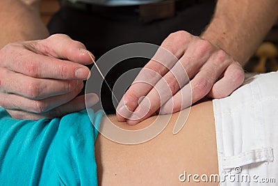 Acupuncture needle female patient back and spine Stock Photo