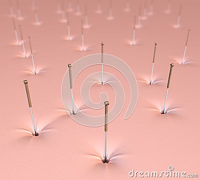 Acupuncture needles in skin surface Stock Photo