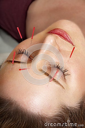 Acupuncture treatment to face Stock Photo