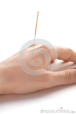 Acupunctured hand (vertical) Stock Photo
