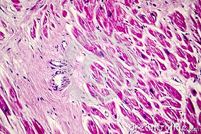 Acute myocardial infarction, histology of heart tissue, light micrograph Stock Photo