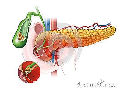 Acute pancreatitis, medically illustration Stock Photo