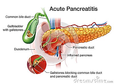 Acute pancreatitis, medically illustration Stock Photo
