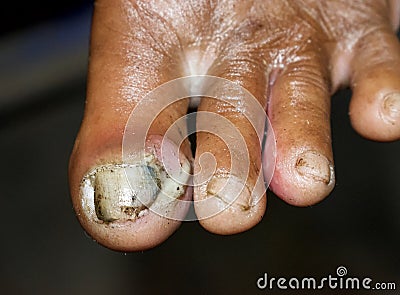 Acute paronychia and tinea pedis at big toe of Southeast Asian elderly woman. Stock Photo