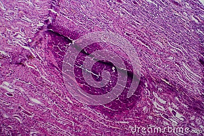 Acute pyelonephritis, light micrograph Stock Photo