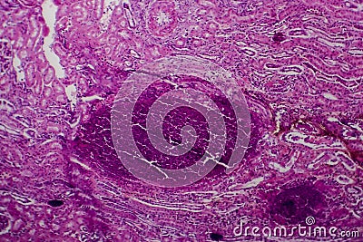 Acute pyelonephritis, light micrograph Stock Photo