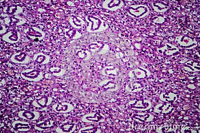 Acute pyelonephritis, light micrograph Stock Photo