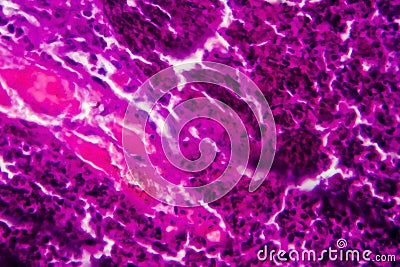 Acute pyelonephritis, light micrograph Stock Photo