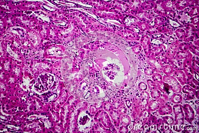 Acute pyelonephritis, light micrograph Stock Photo